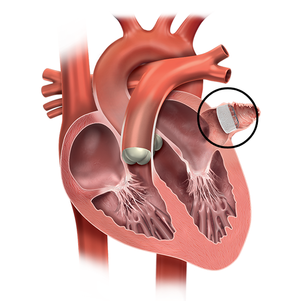 Detailed human heart showing internal anatomy with a focus on the catheter ablation area using LAAC with WATCHMAN FLEX.