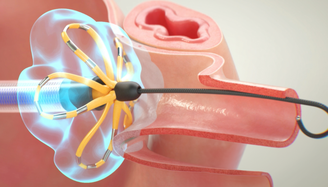 FARAPULSE™ PFA Catheter conforms to diverse pulmonary vein anatomies, ensuring efficient and reproducible results