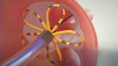 Discover FARAPULSE PFA system and how it works.