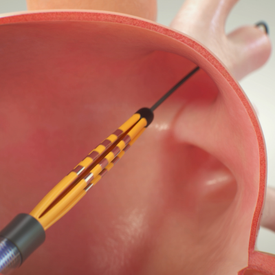 Discover FARAPULSE PFA system and how it works.
