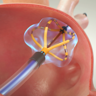 Discover FARAPULSE PFA system and how it works.