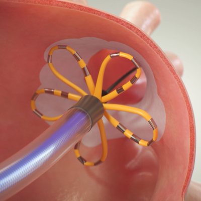 Discover FARAPULSE PFA system and how it works.